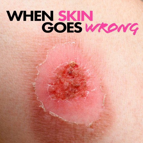 When Skin Goes Wrong